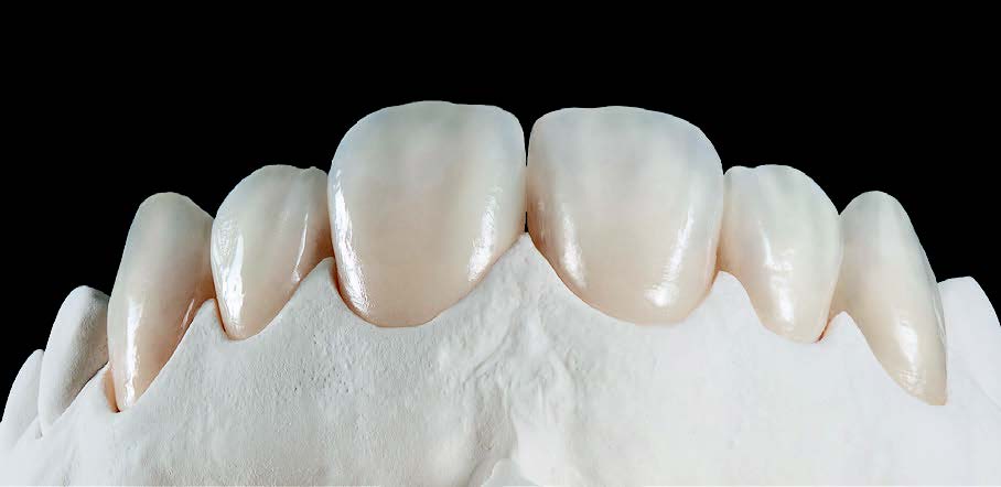 Cementation Of Zirconia: Considerations for Optimal Results